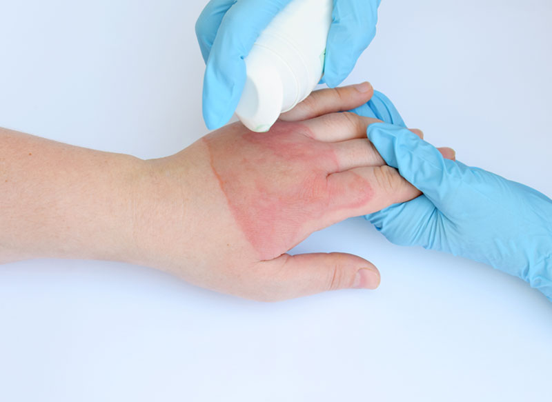 Burn Deformity Surgeries