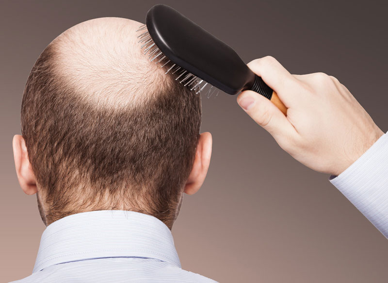 Hair Transplant